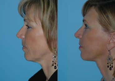 Before and after Facelift by Dr. Shervin Naderi, Patient 8906