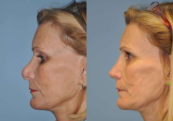 Before and after Revision Rhinoplasty by Dr. Shervin Naderi, Patient 8896