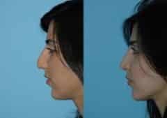 Before and after Rhinoplasty by Dr. Shervin Naderi, Patient 8844