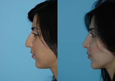 Before and after Rhinoplasty by Dr. Shervin Naderi, Patient 8844