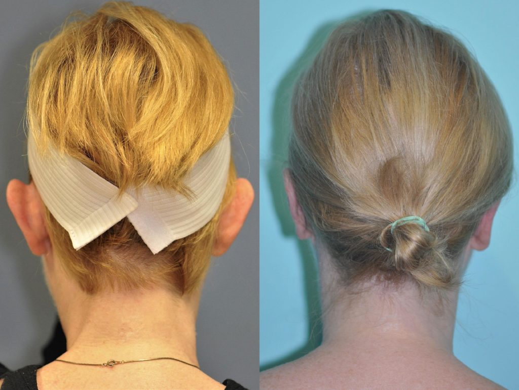 Otoplasty photos Chevy Chase, MD Patient 11588