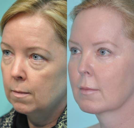 Before and after Blepharoplasty by Dr. Shervin Naderi, Patient 11850