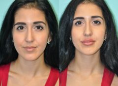 Before and after Lip Augmentation by Dr. Shervin Naderi, Patient 11858