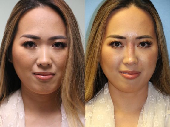 Before and after Non-Surgical Rhinoplasty by Dr. Shervin Naderi, Patient 11854