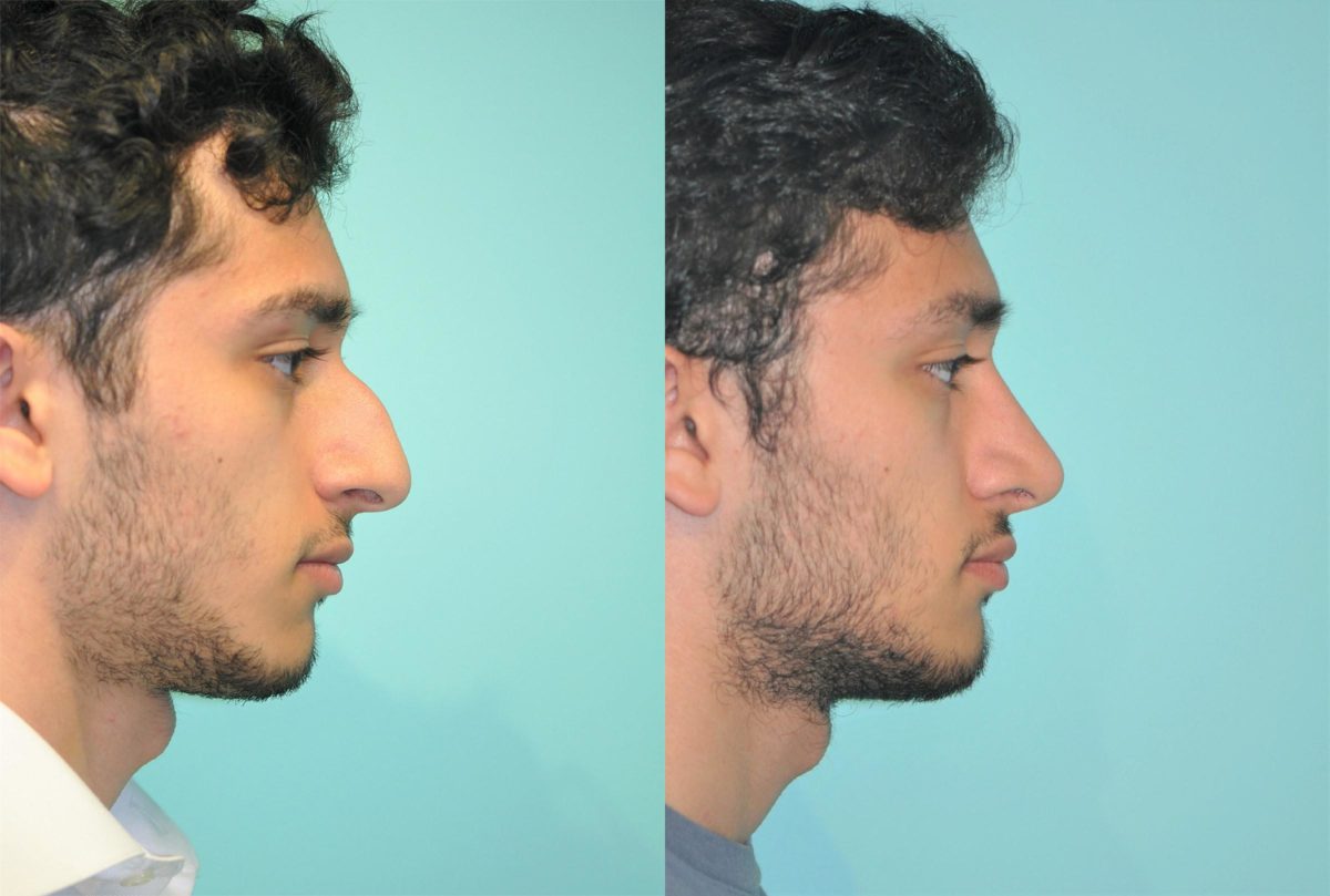 Before and after Rhinoplasty by Dr. Shervin Naderi, Patient 11846