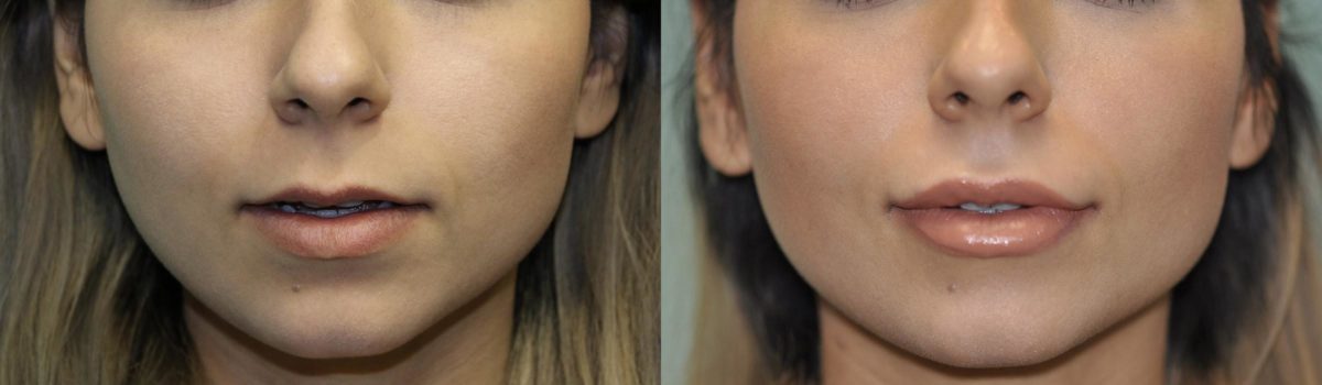 Before and after Lip Augmentation by Dr. Shervin Naderi, Patient 11884