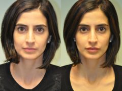 Before and after Lip Augmentation by Dr. Shervin Naderi, Patient 11888