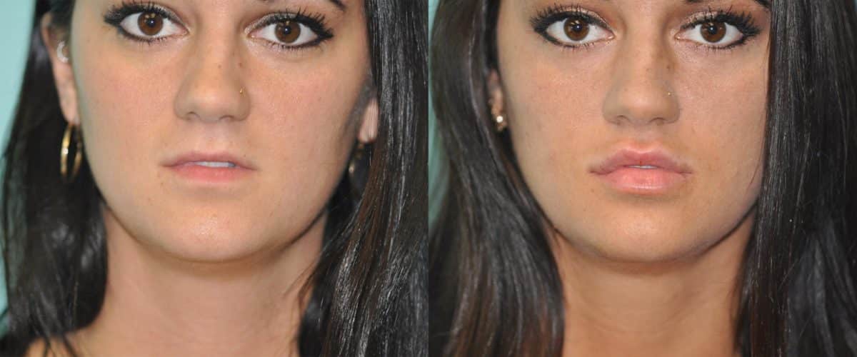 Before and after Lip Augmentation by Dr. Shervin Naderi, Patient 11907