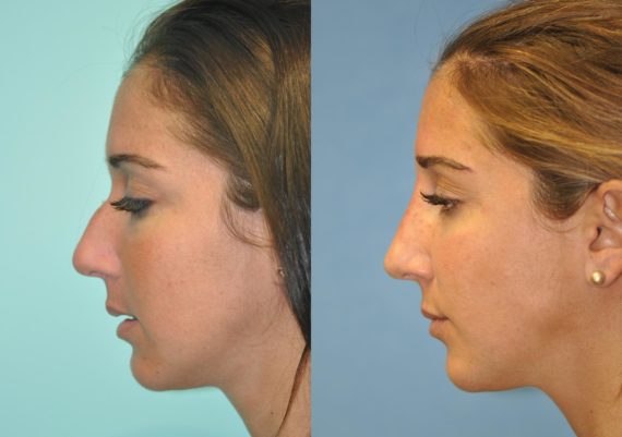 Before and after Non-Surgical Rhinoplasty by Dr. Shervin Naderi, Patient 11935