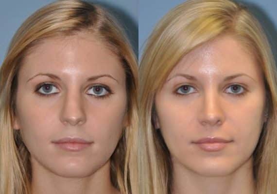 Before and after Revision Rhinoplasty by Dr. Shervin Naderi, Patient 8895