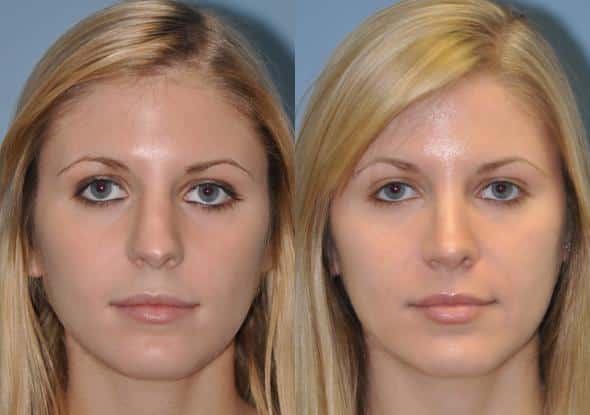 Before and after Revision Rhinoplasty by Dr. Shervin Naderi, Patient 8895