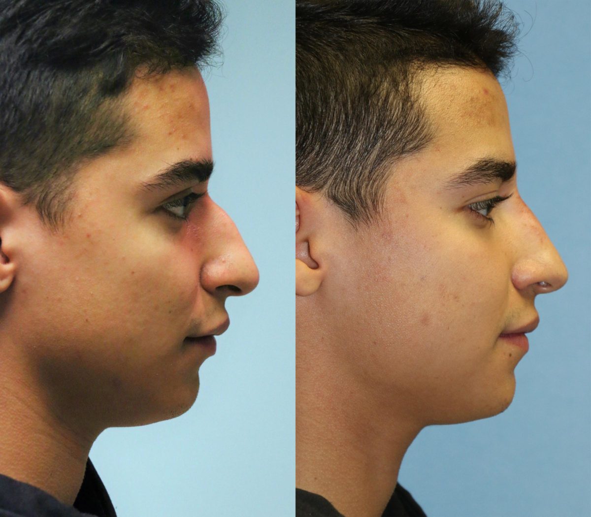 Before and after Non-Surgical Rhinoplasty by Dr. Shervin Naderi, Patient 11871