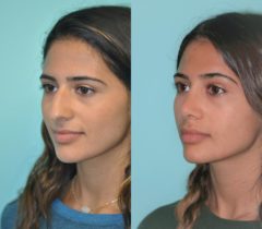 Before and after Rhinoplasty by Dr. Shervin Naderi, Patient 11867