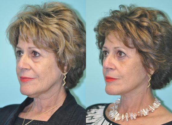 Before and after Facelift by Dr. Shervin Naderi, Patient 12001