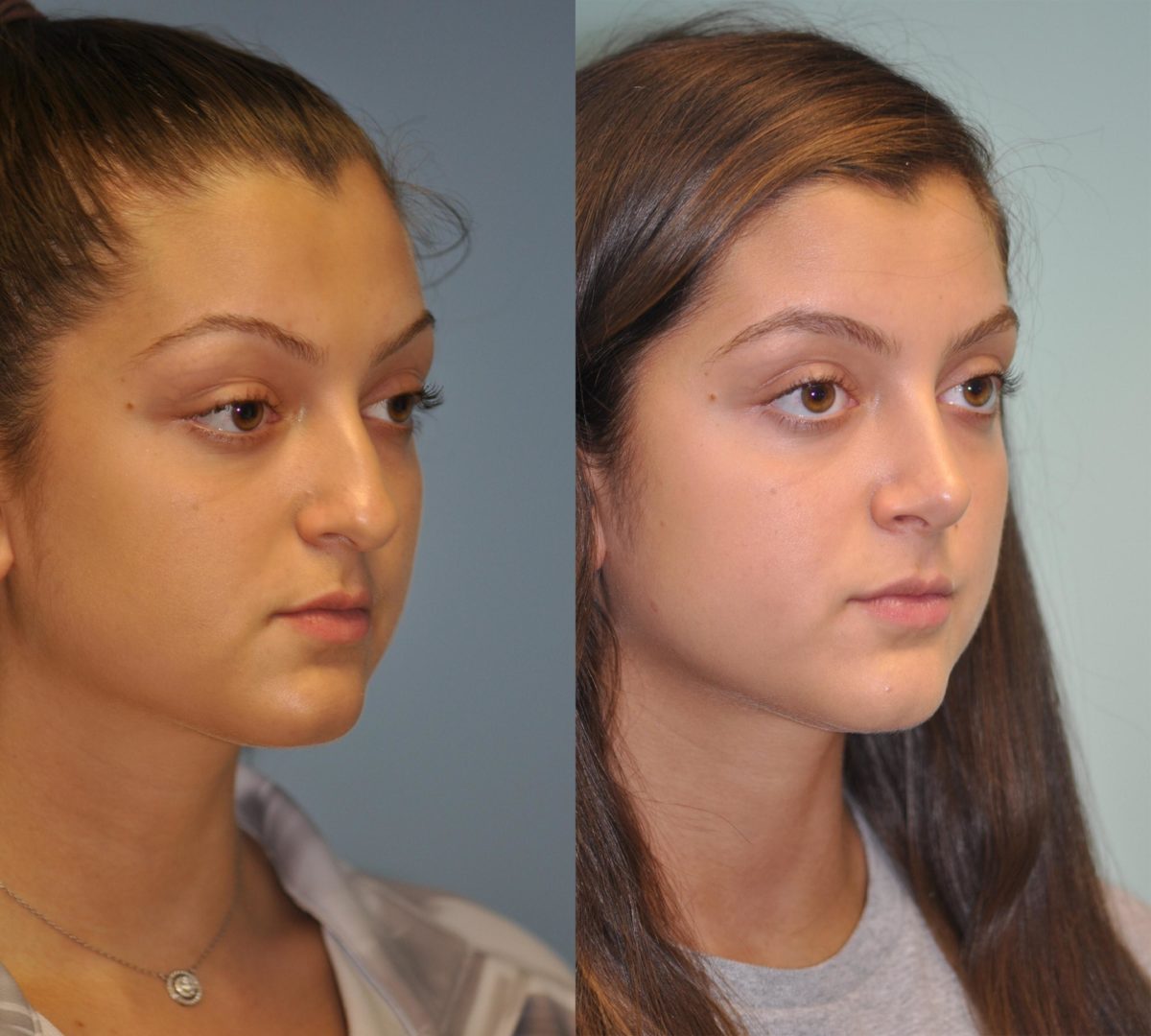 Before and after Rhinoplasty by Dr. Shervin Naderi, Patient 11953