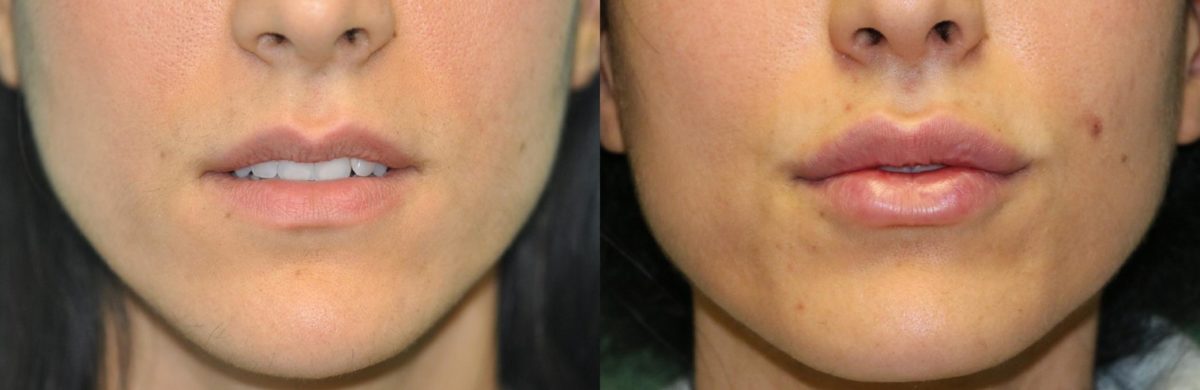 Before and after Lip Augmentation by Dr. Shervin Naderi, Patient 12068