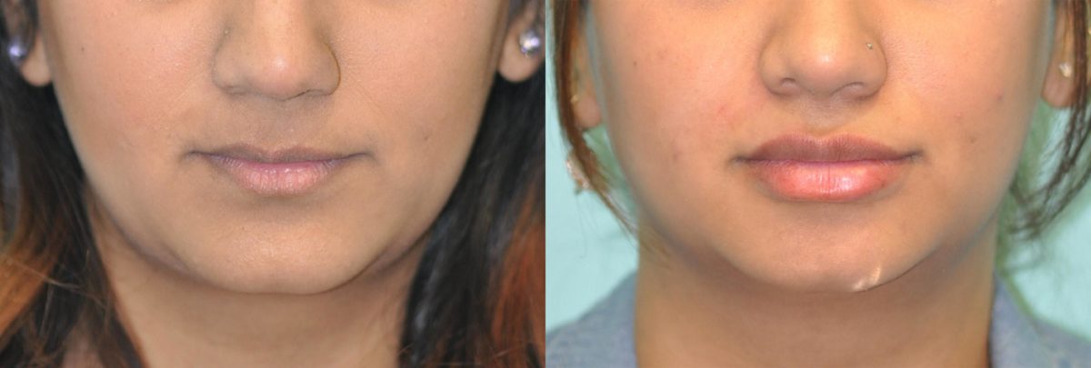 Before and after Lip Implant by Dr. Shervin Naderi, Patient 12043