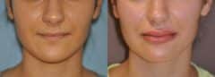 Before and after Lip Implant by Dr. Shervin Naderi, Patient 12026