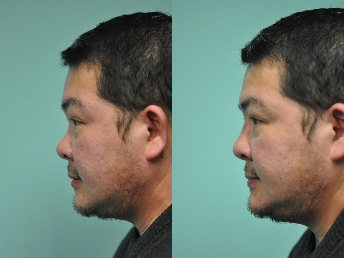 Before and after Non-Surgical Rhinoplasty by Dr. Shervin Naderi, Patient 12030