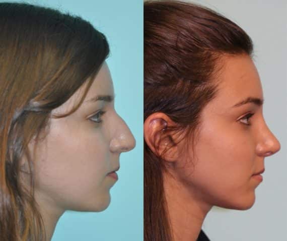 Before and after Rhinoplasty by Dr. Shervin Naderi, Patient 12054