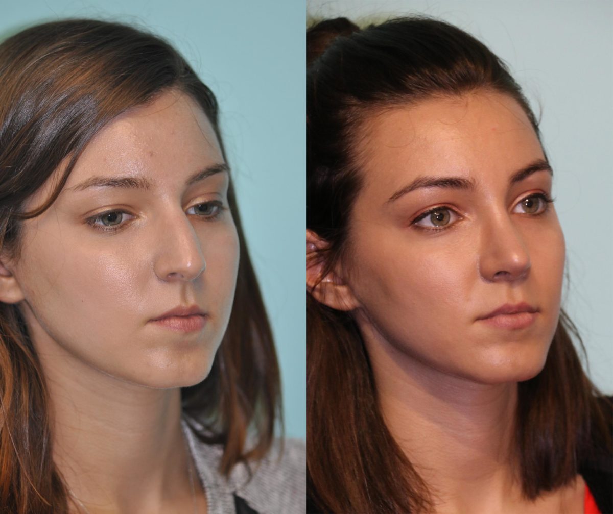 Before and after Rhinoplasty by Dr. Shervin Naderi, Patient 12054