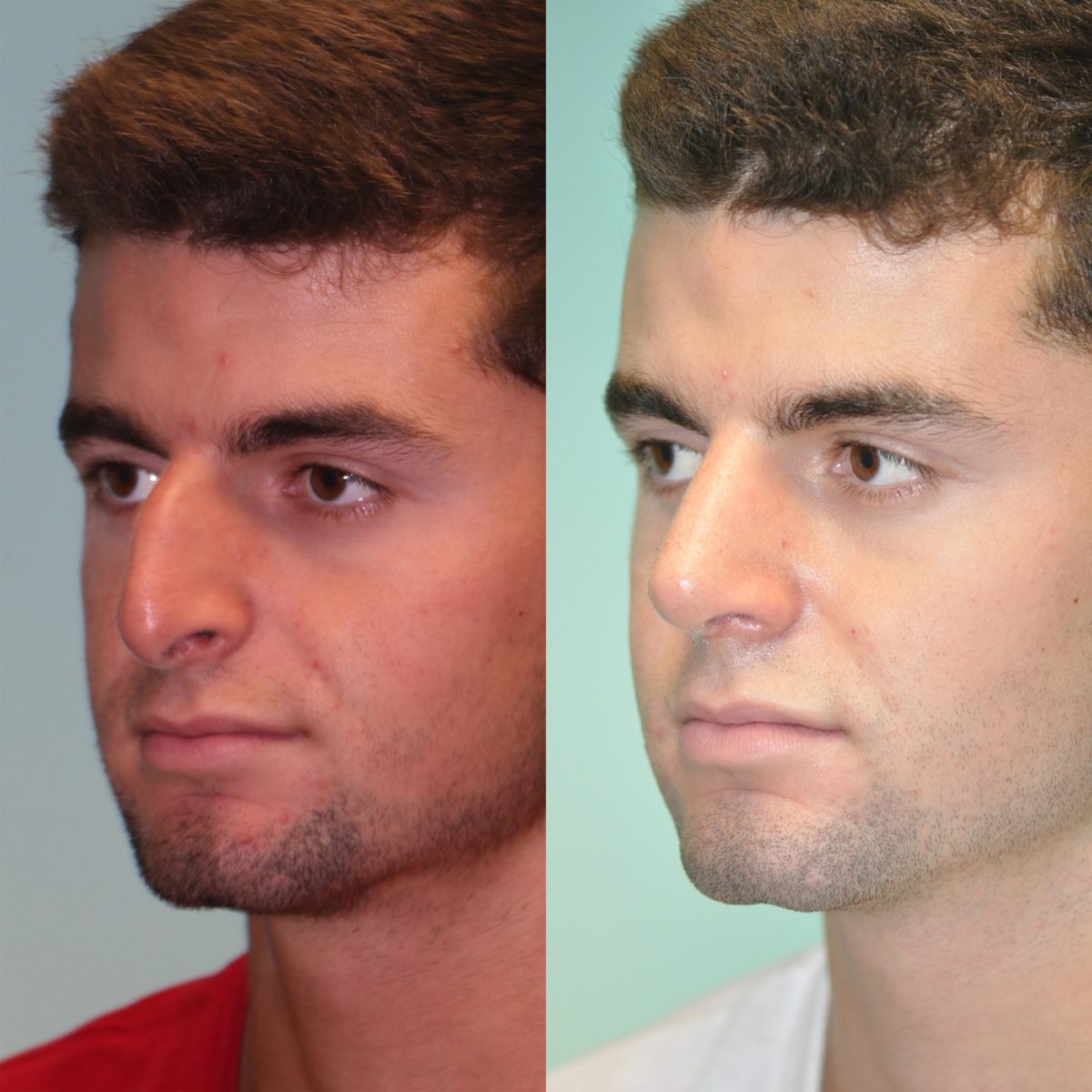 Before and after Rhinoplasty by Dr. Shervin Naderi, Patient 12061