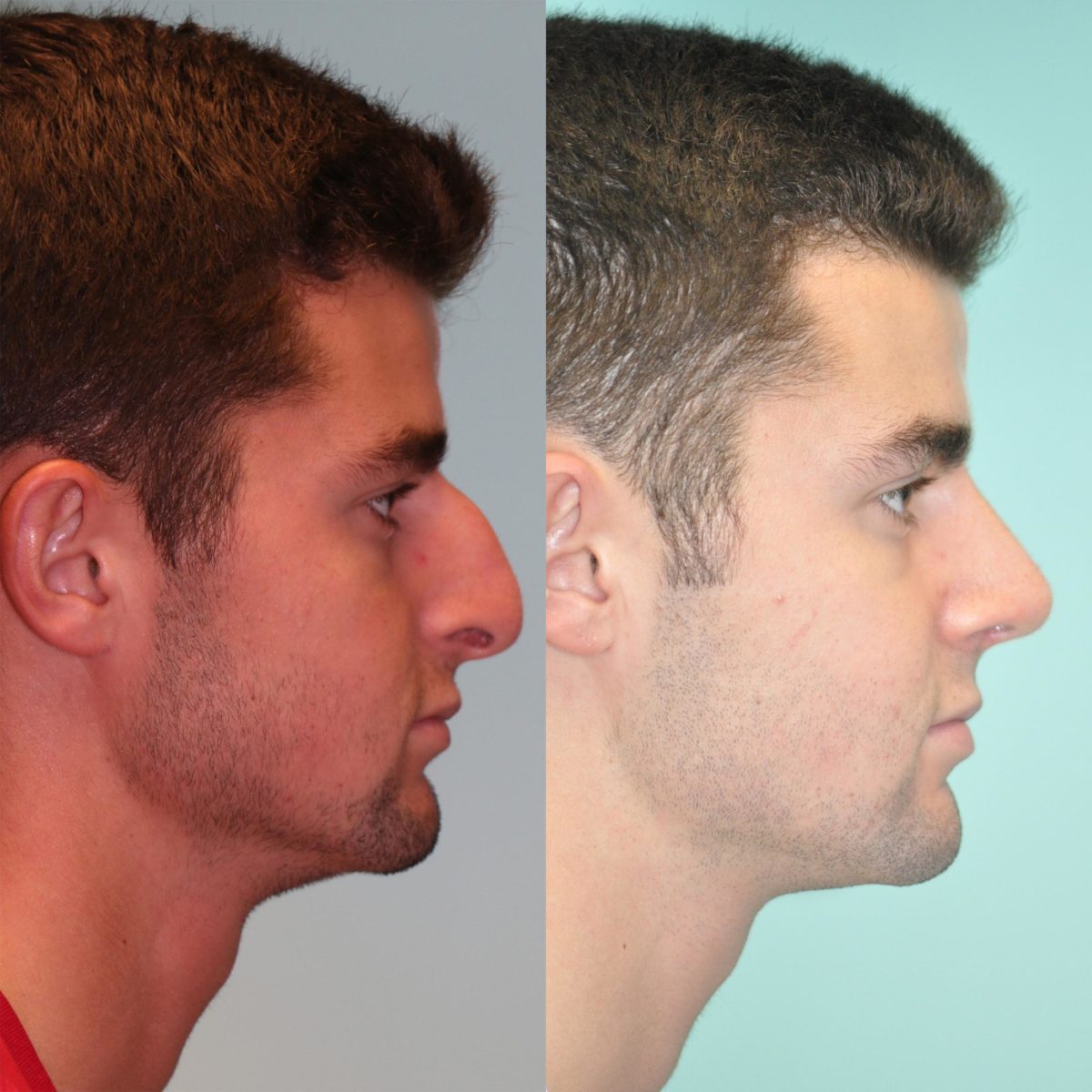 Before and after Rhinoplasty by Dr. Shervin Naderi, Patient 12061