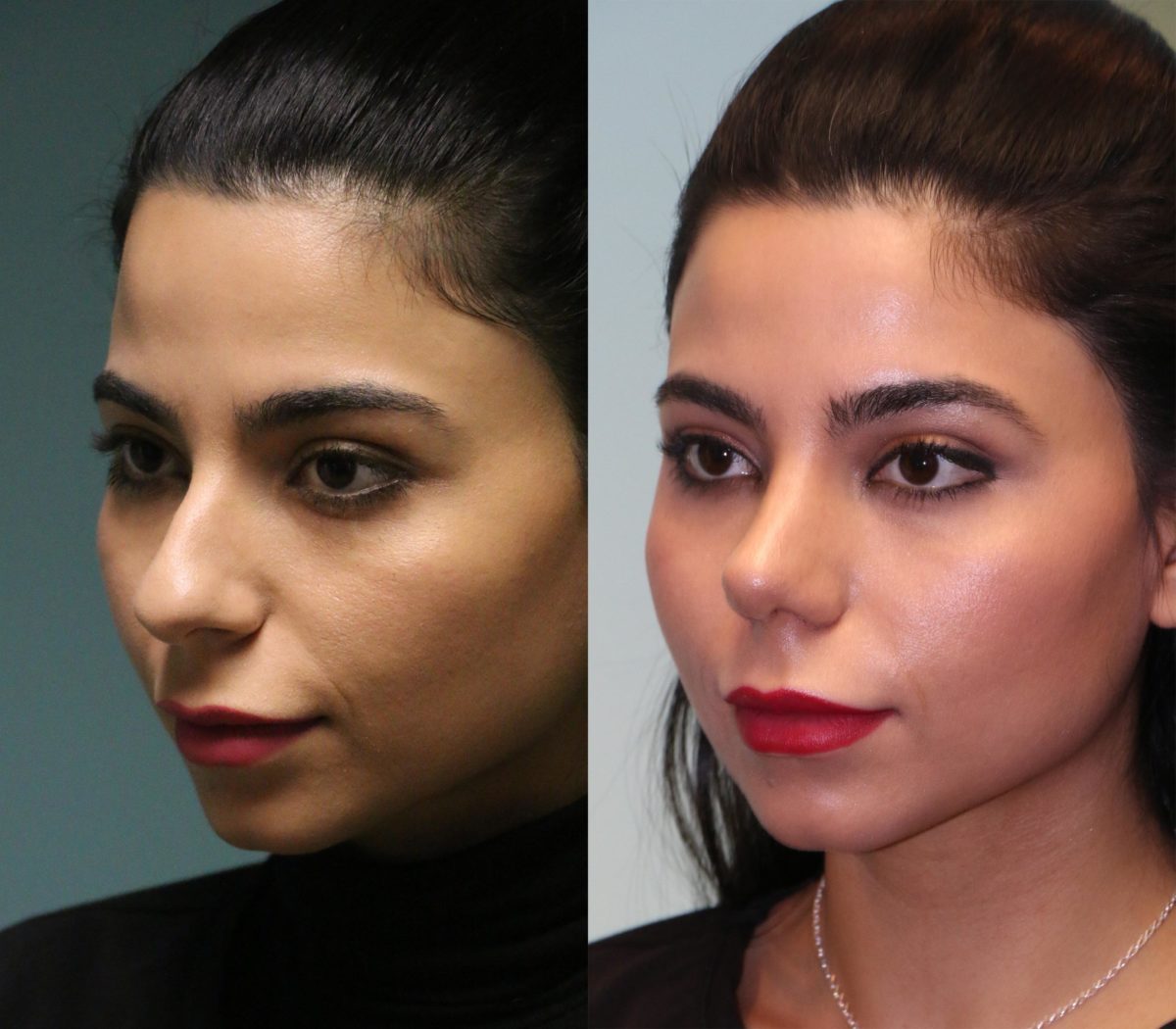 Before and after Rhinoplasty by Dr. Shervin Naderi, Patient 12142