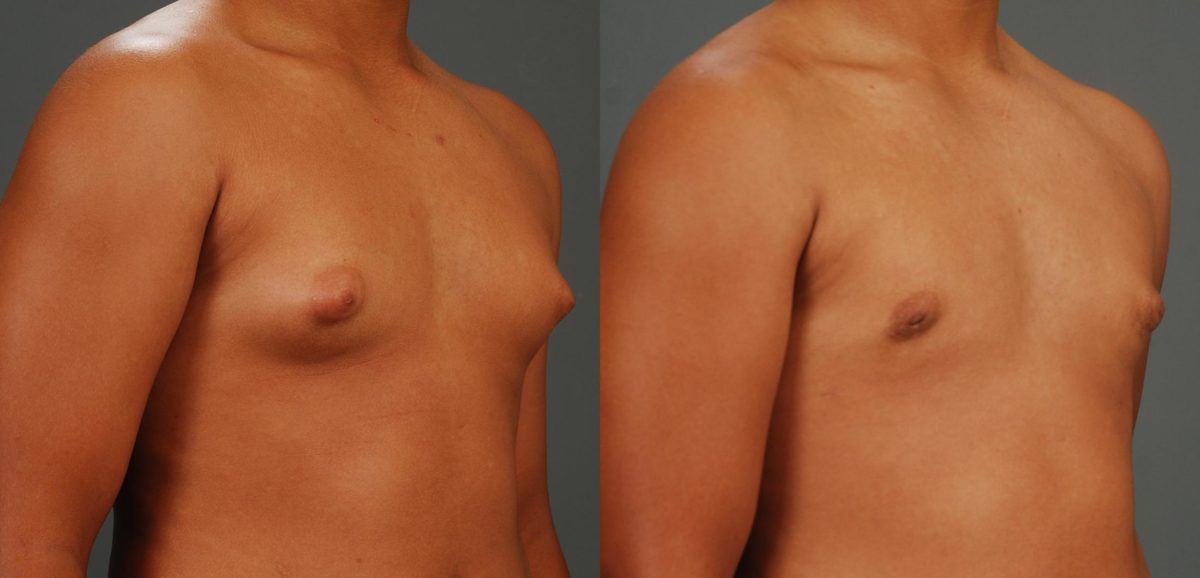 Before and after Gynecomastia by Dr. Shervin Naderi, Patient 11216