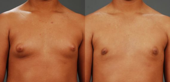 Before and after Gynecomastia by Dr. Shervin Naderi, Patient 11216