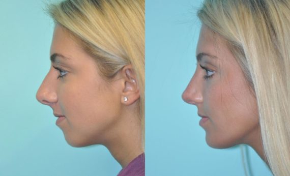 Before and after Chin & Facial Implant by Dr. Shervin Naderi, Patient 11614