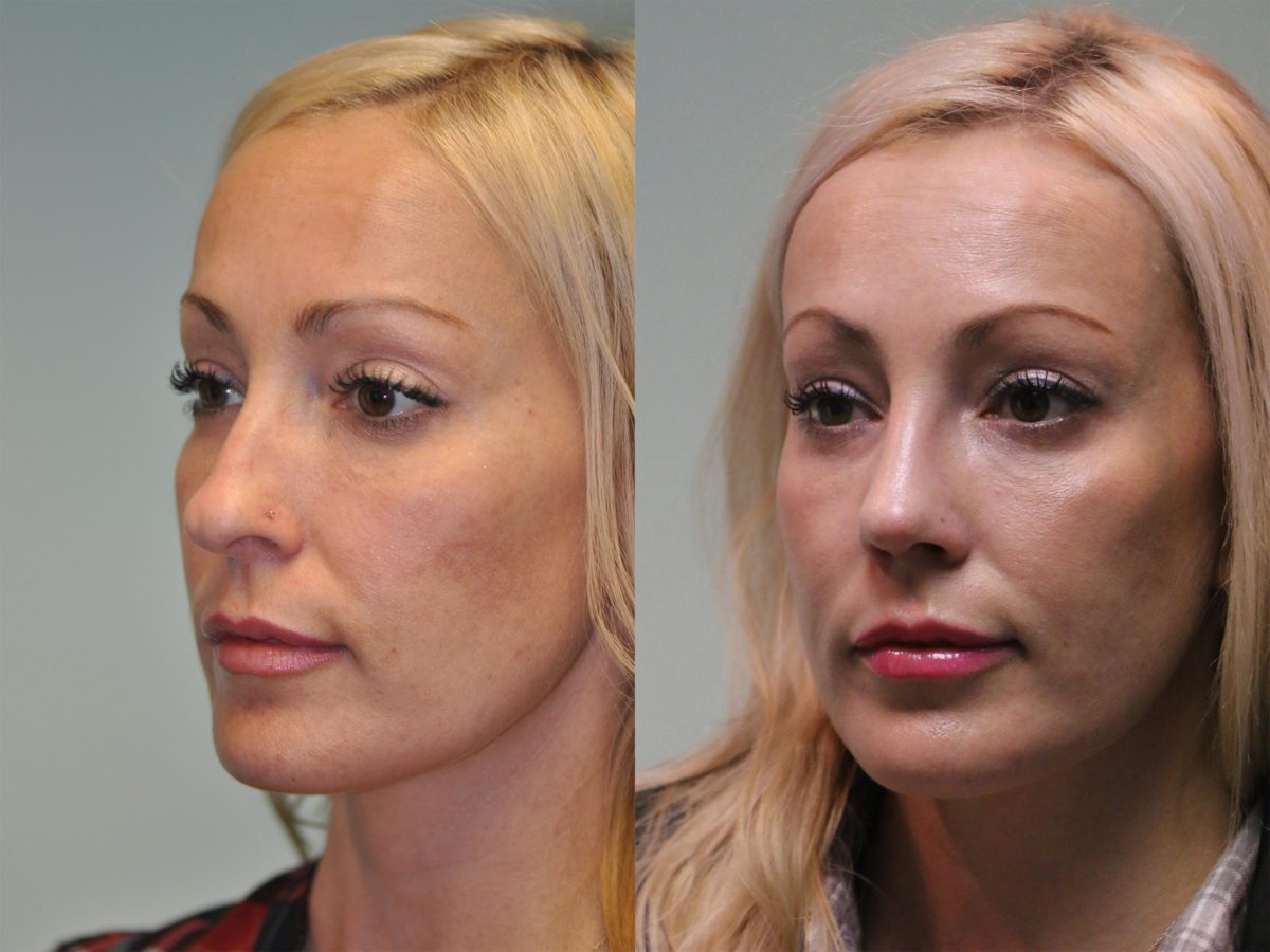 Before and after Rhinoplasty by Dr. Shervin Naderi, Patient 12181