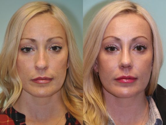 Before and after Rhinoplasty by Dr. Shervin Naderi, Patient 12181