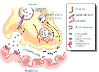 Botox® works at the nicotinic nerve ending, preventing the release of the acetylcholine neurotransmitter vesicles.