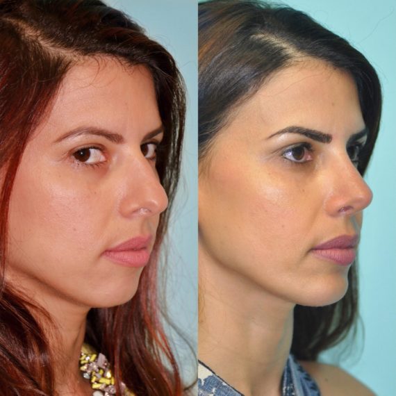 Before and after Chin & Facial Implant by Dr. Shervin Naderi, Patient 12273