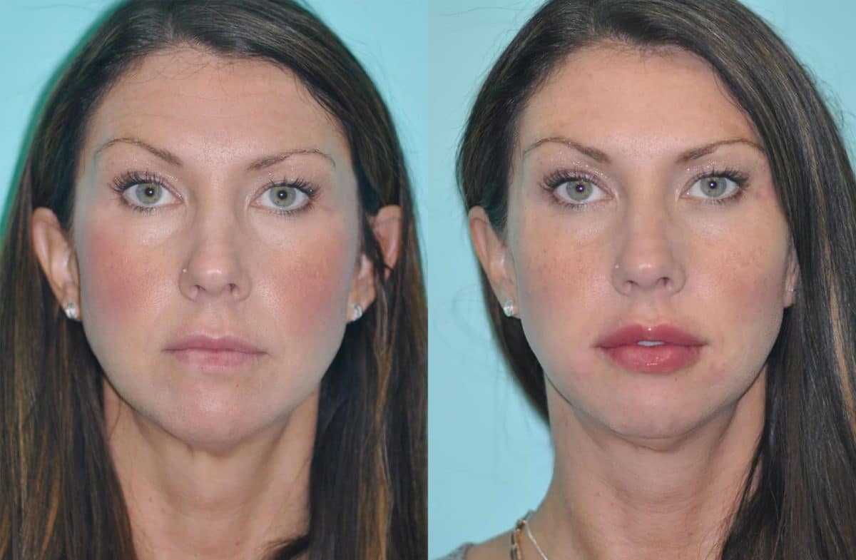 Before and after Lip Augmentation by Dr. Shervin Naderi, Patient 12393