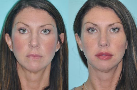 Before and after Lip Augmentation by Dr. Shervin Naderi, Patient 12393