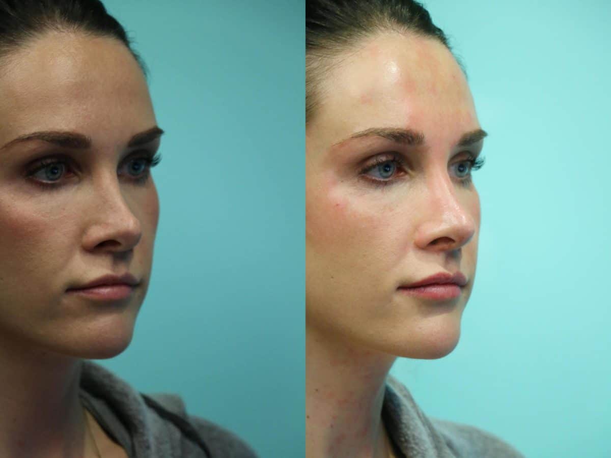 Before and after Non-Surgical Rhinoplasty by Dr. Shervin Naderi, Patient 12357