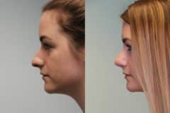 Before and after Rhinoplasty by Dr. Shervin Naderi, Patient 12361