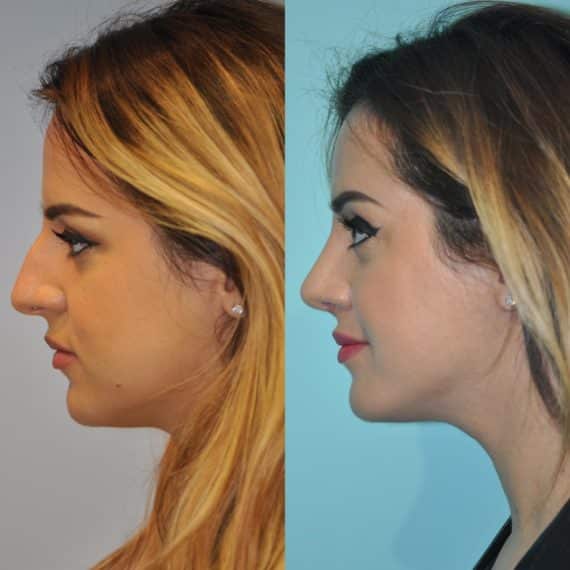 Before and after Rhinoplasty by Dr. Shervin Naderi, Patient 12269