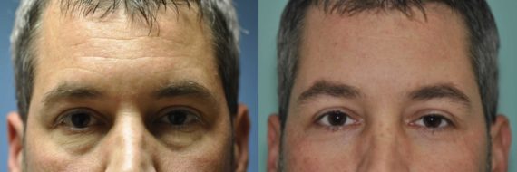 Before and after Blepharoplasty by Dr. Shervin Naderi, Patient 12571