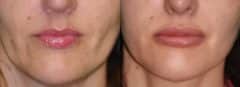 Before and after Lip Implant by Dr. Shervin Naderi, Patient 12555