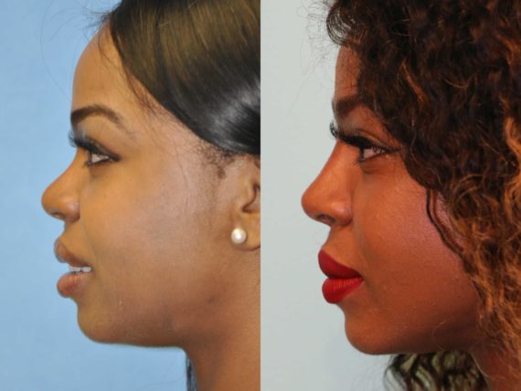 Before and after Non-Surgical Rhinoplasty by Dr. Shervin Naderi, Patient 12540