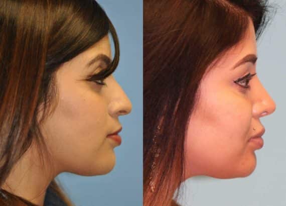 Before and after Rhinoplasty by Dr. Shervin Naderi, Patient 12521