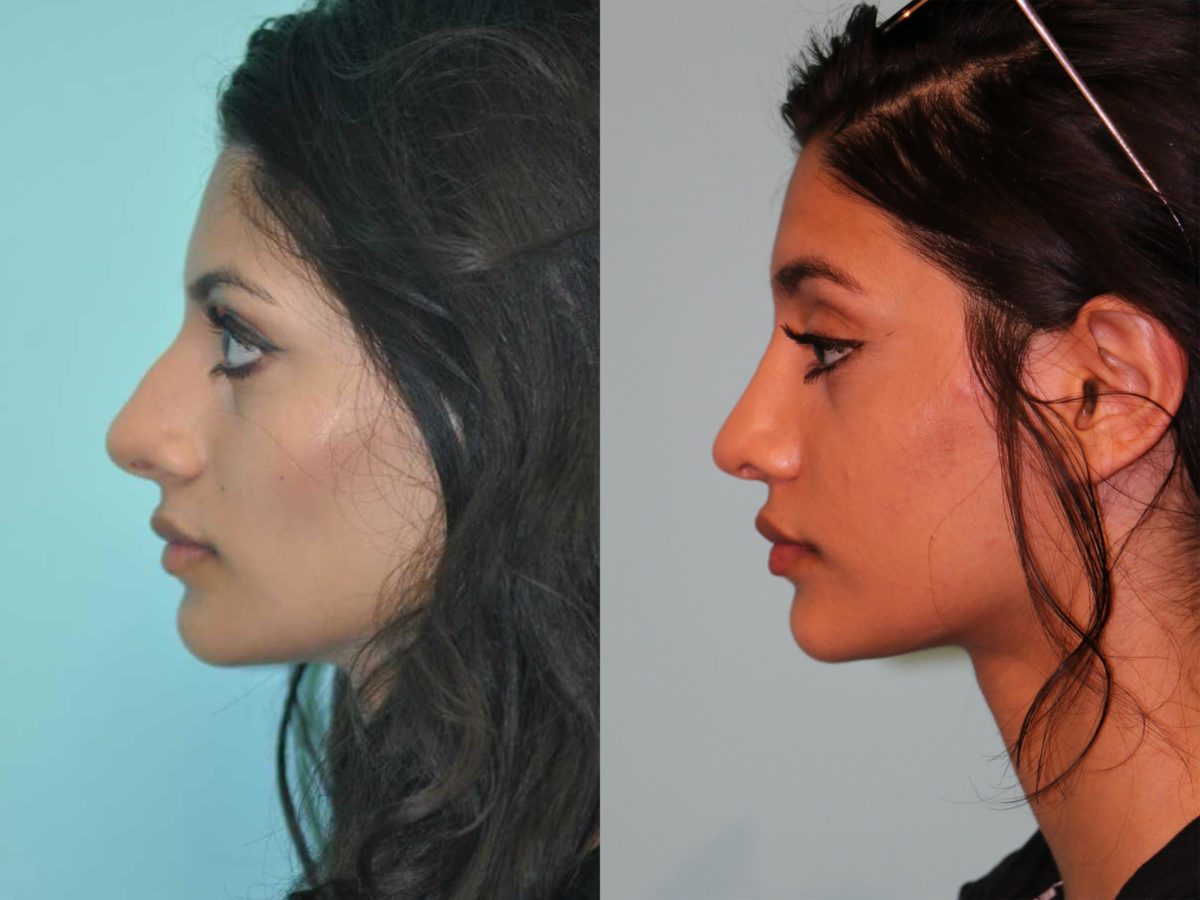 Before and after Rhinoplasty by Dr. Shervin Naderi, Patient 12499