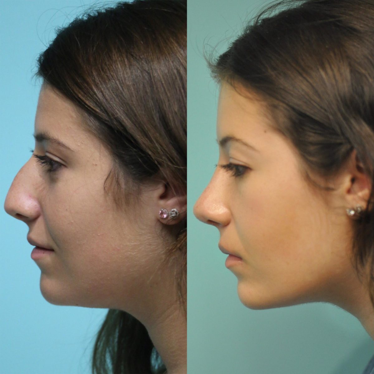 Before and after Rhinoplasty by Dr. Shervin Naderi, Patient 12493