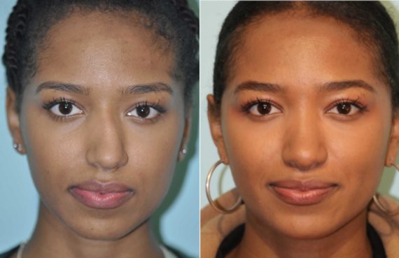 Before and after Rhinoplasty by Dr. Shervin Naderi, Patient 12566