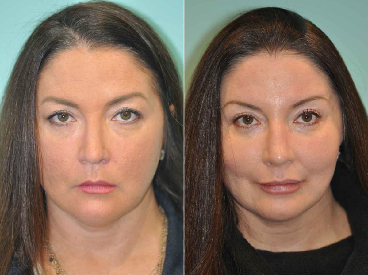 Before and after Blepharoplasty by Dr. Shervin Naderi, Patient 12775