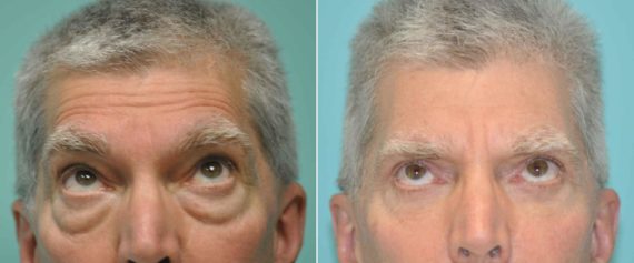 Before and after Blepharoplasty by Dr. Shervin Naderi, Patient 12767