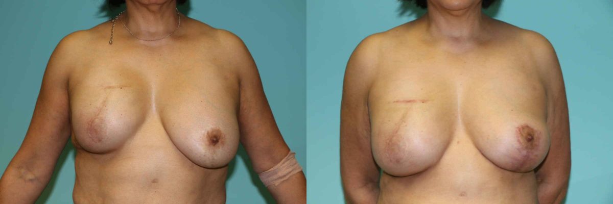 Before and after Breast Reconstruction by Dr. Shervin Naderi, Patient 12659